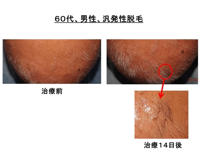 円形脱毛症　病院""